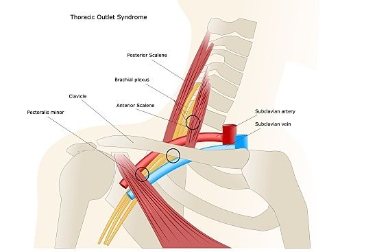 thoracic outlet syndrome 
